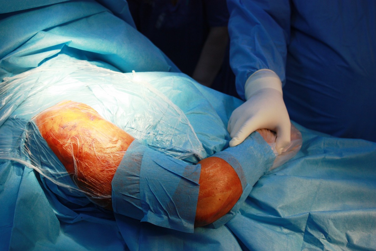Proteza de umar - in ce conditii este recomandata si cum decurge operatia | MedLife