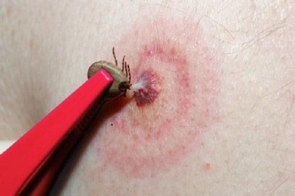 Peste 900 de sibieni mușcați de căpușe în 2019. Opt cazuri de boală Lyme