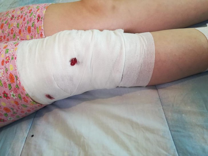 Fetiță de zece ani mușcată rău de un câine. „I-a dat sandvișul și maidanezul a sărit la ea”