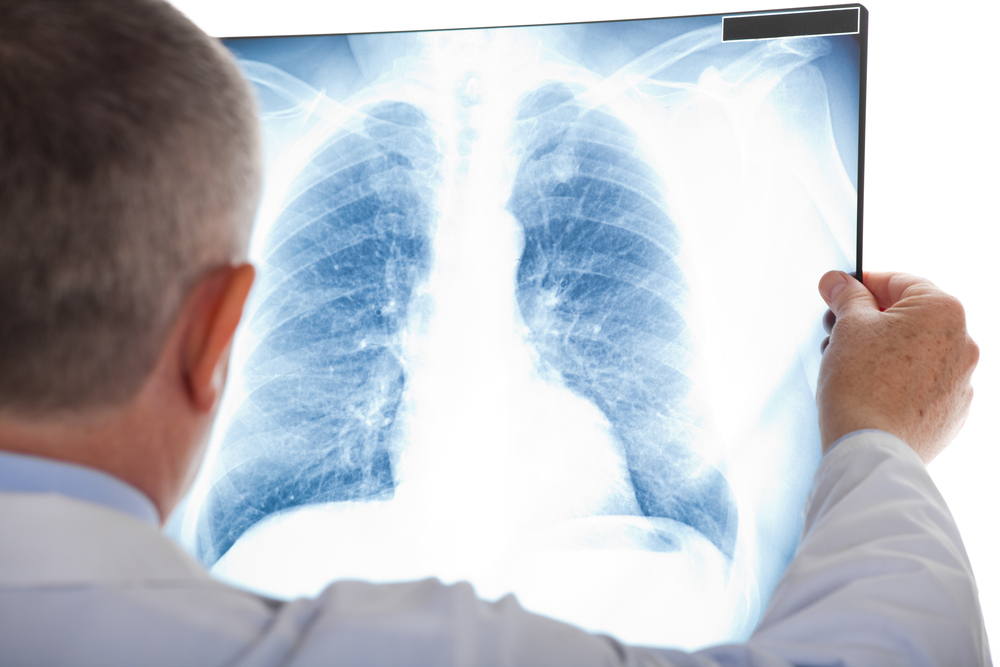 BioNTech şi Regeneron avansează în dezvoltarea unui medicament pentru cancerul pulmonar