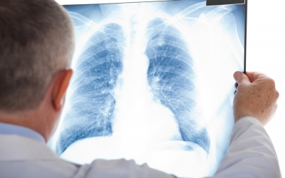BioNTech şi Regeneron avansează în dezvoltarea unui medicament pentru cancerul pulmonar
