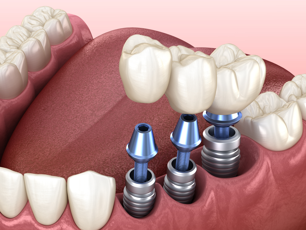 Previs site Terminology Pathetic De câte tipuri sunt coroanele dentare și cum să-l alegi pe cel mai potrivit  pentru