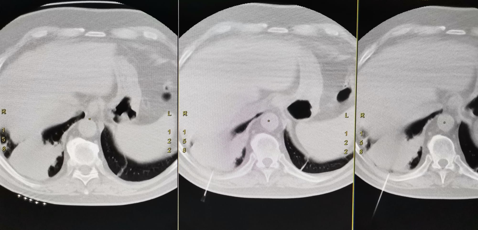 La Spitalul Județean a fost realizată prima biopsie pulmonară ghidată prin CT. Chelcea: „Pacienții oncologici primesc o șansă în plus la depistare precoce”