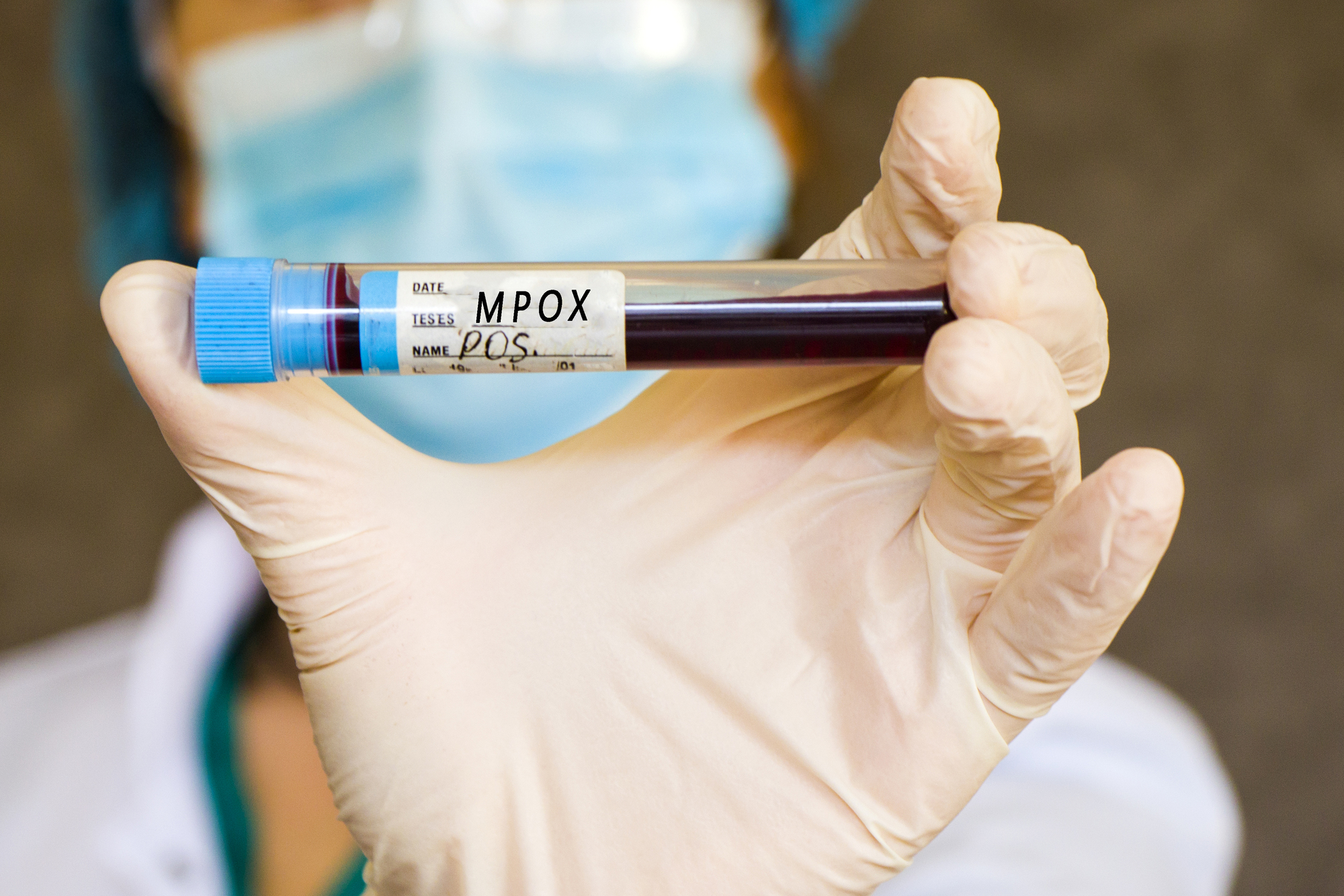Mpox nu este noul COVID, spune un oficial OMS