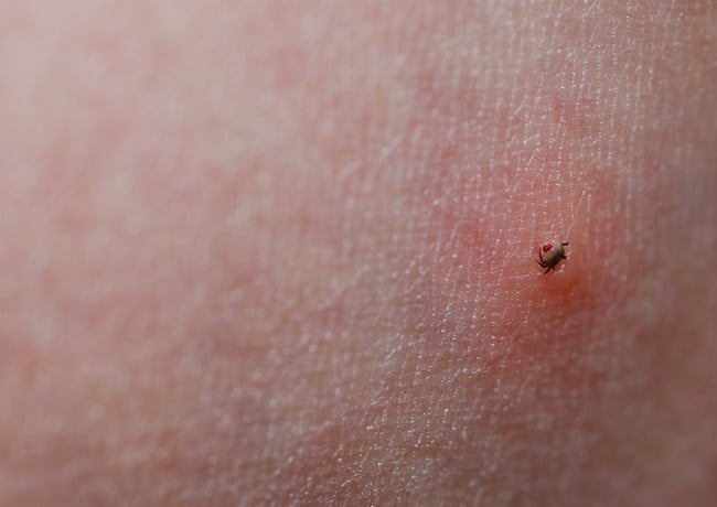 tick and skin