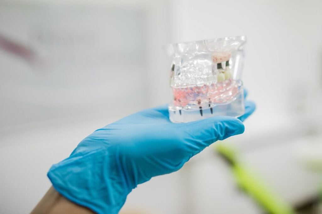 implant dentar