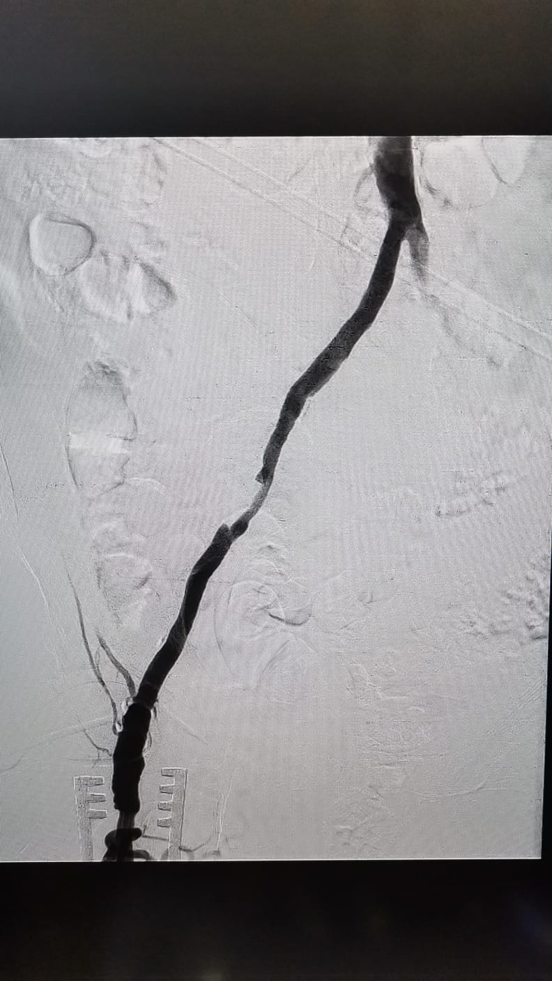 Pentru prima dată la Sibiu, doctorii de la Spitalul Județean au realizat o endarterectomie combinată cu angioplastie și stenting