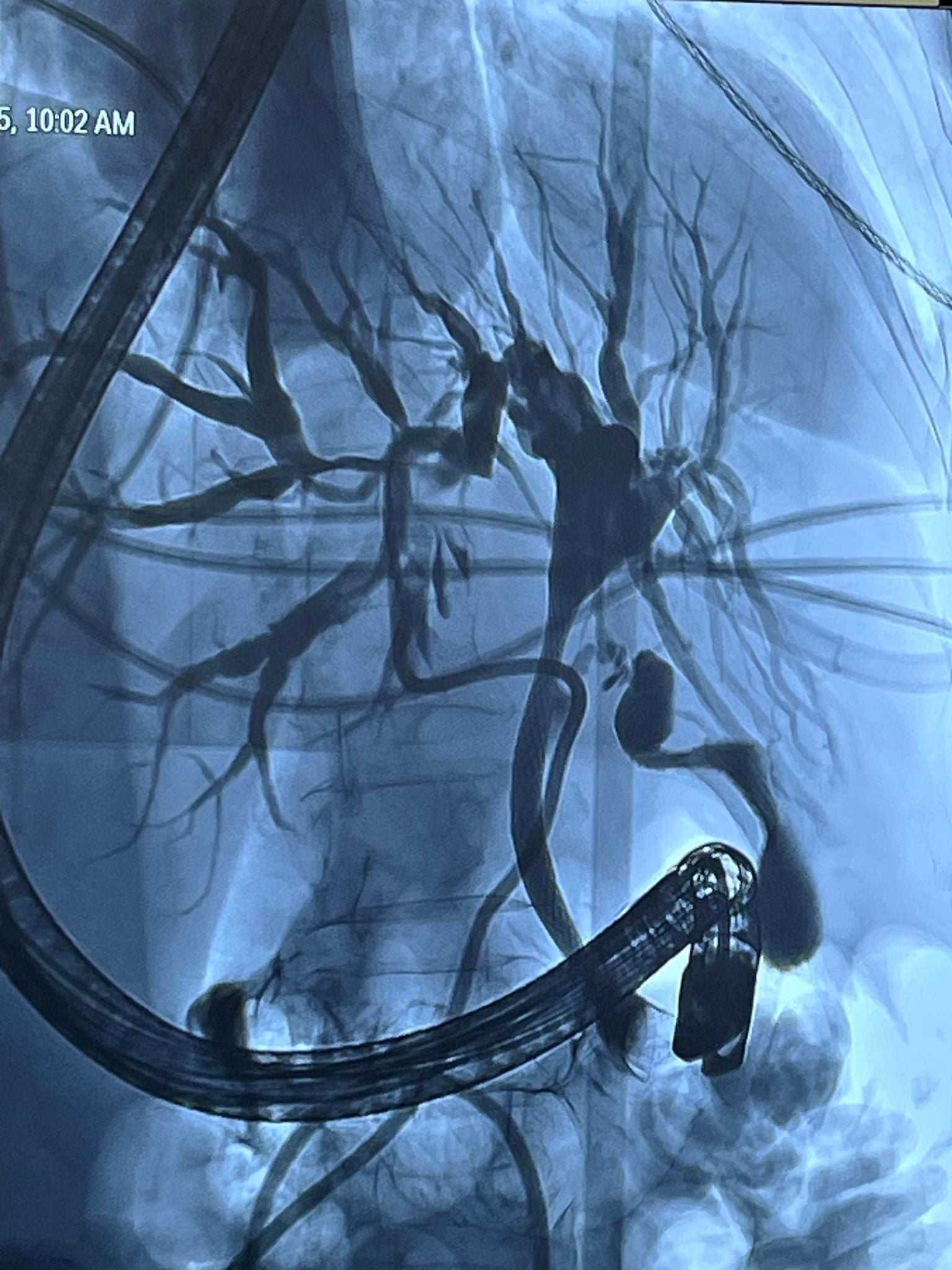 Premieră medicală la Spitalul Județean Sibiu: intervenție complexă pentru tratarea unei afecțiuni biliare severe